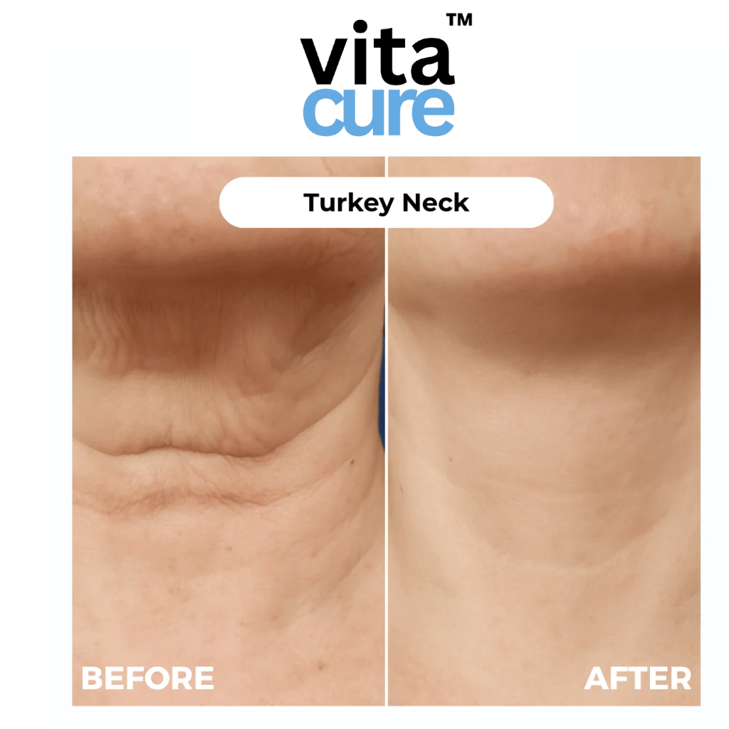 Vitacure™ – Anti-Wrinkle Freeze-Dried Nano-Silk Collagen System